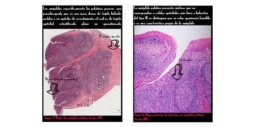 histología de las amígdalas faríngeas